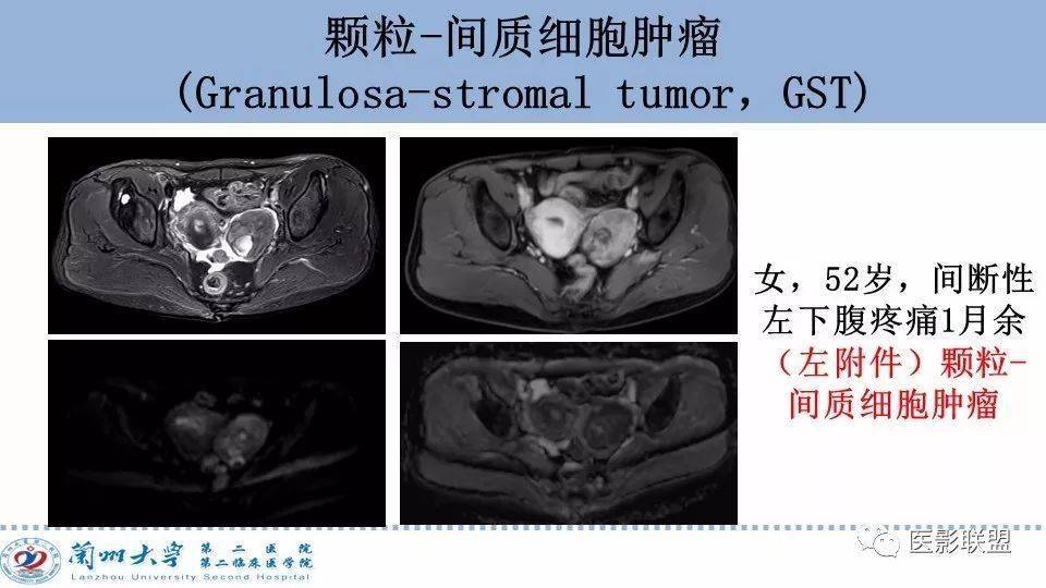 精彩ppt卵巢腫瘤mri診斷