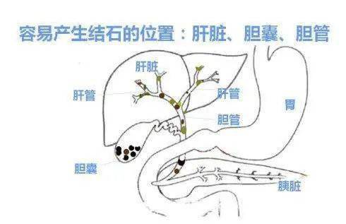 肝内胆管结石位置图图片