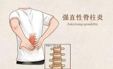 中医 强直性脊柱炎 强直性脊柱炎的表现 关节骨骼 脏器器官 全身性表现 患者