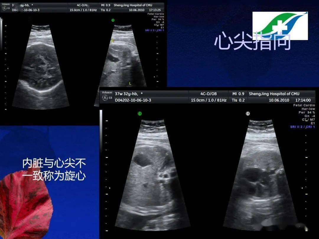 胎儿超声心动图基础及切面