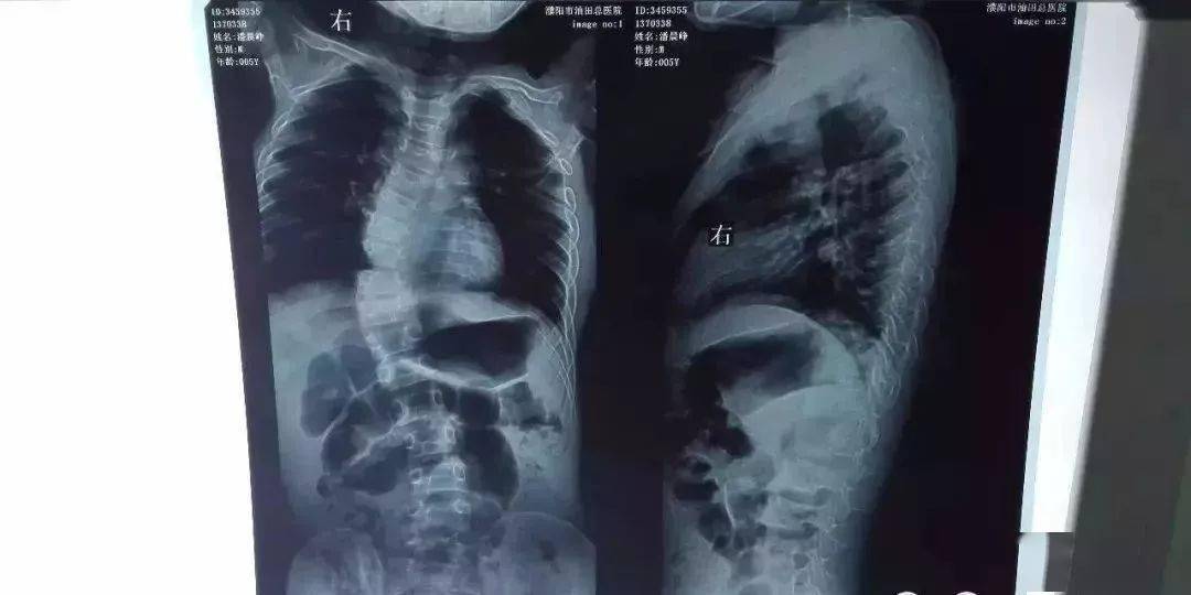 详细学习脊柱侧弯评估与康复