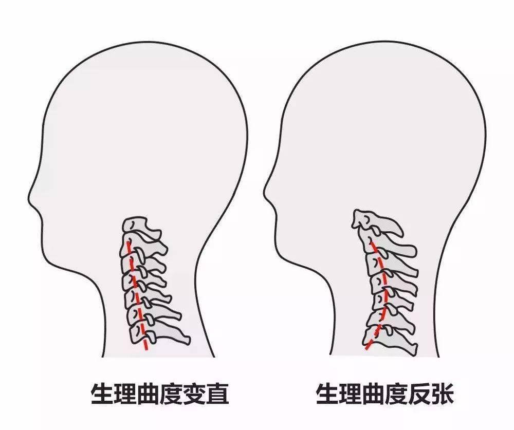 你的頸椎,用著用著就變