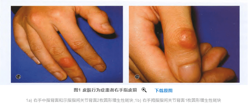 忍不住地撕死皮抠指甲会不会发展成可怕的强迫性皮肤剥离症