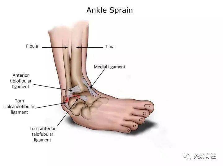 今夜一读,不慎崴脚后,您应该知道这些