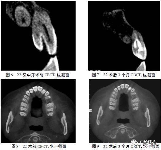 錐形束ct在上頜側切牙牙中牙診療中的輔助應用1例