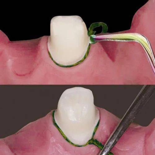 牙体制备中排龈线的使用方法