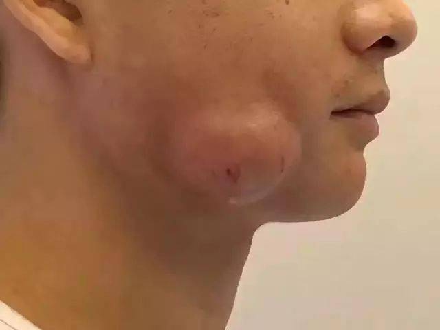 一张帅气的脸被智齿毁容了,你的智齿还好吗