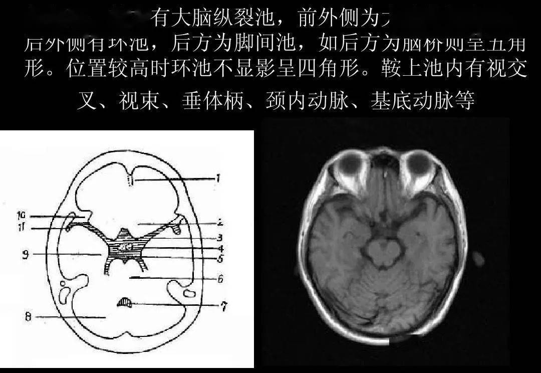 脑室系统 = 侧脑室 第三脑室 第四脑室 (第五脑室 第六脑室) 中脑水管