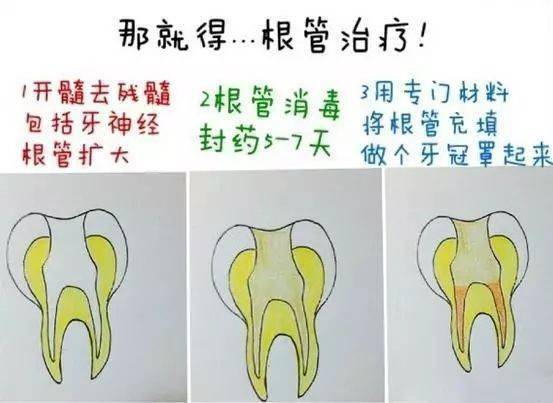 补牙:治疗蛀牙最主要的方法就是补牙,就是将"蛀"的部分去除净,做成
