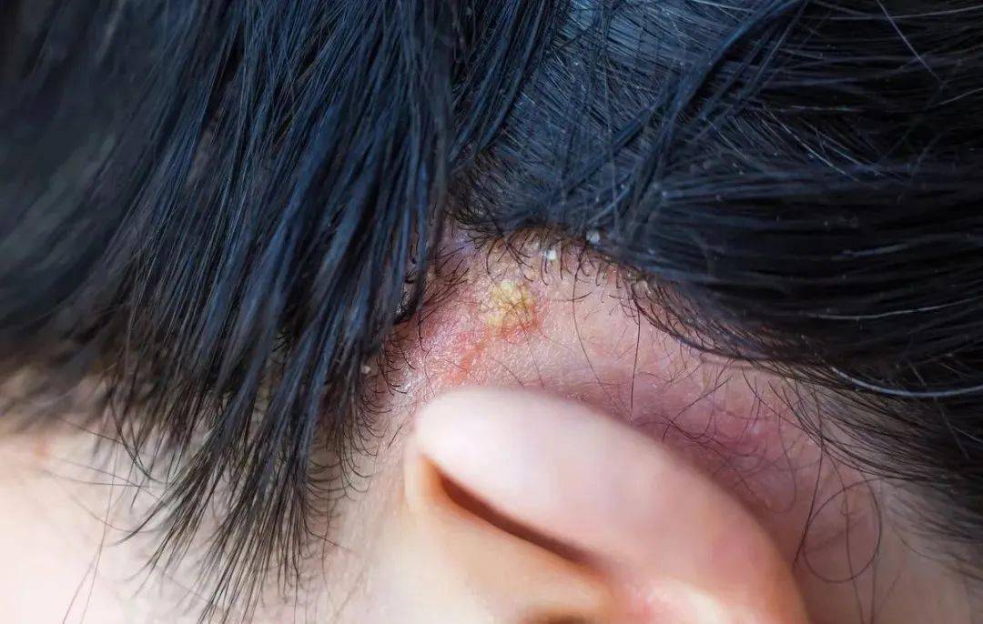 头屑总是满天飞,掉不完,可能是这种疾病的警告信号