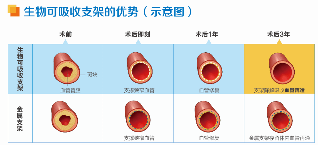 乐普冠脉支架图片