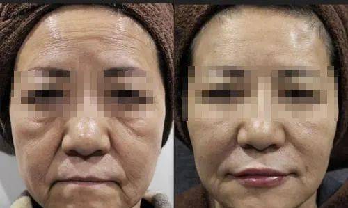 往脸上贴这个,抬头纹没了,整个人都年轻了,男女通用