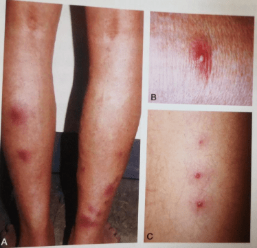 白塞病的临床表现,你知多少?_病变