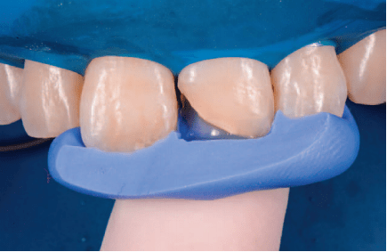 避免牙面处理剂飞溅至左右邻牙,使用特氟龙胶带保护,选择性酸蚀牙釉质