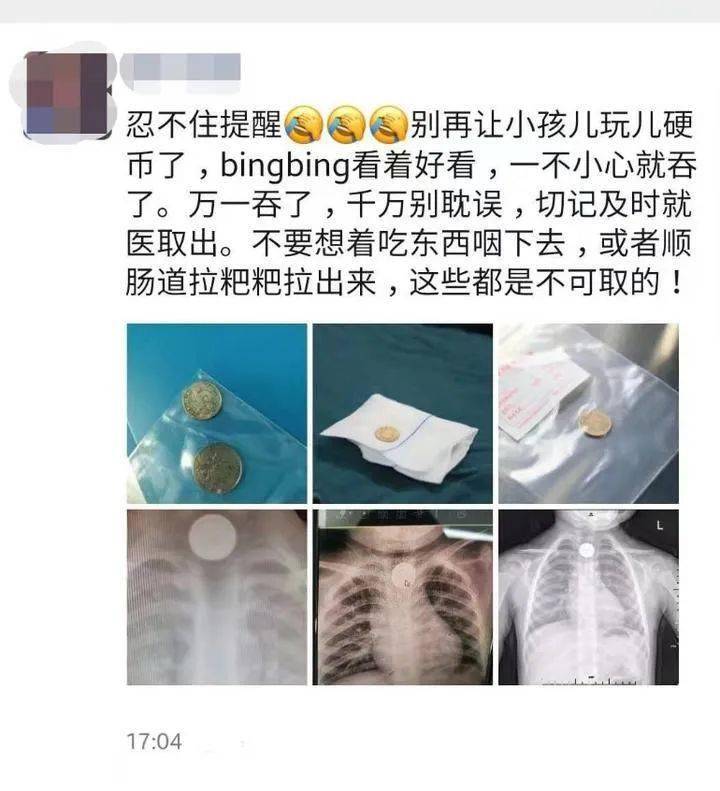 而除了吞硬币外,还有孩子会误吞药片的塑料薄膜,小塑料片等等小物件