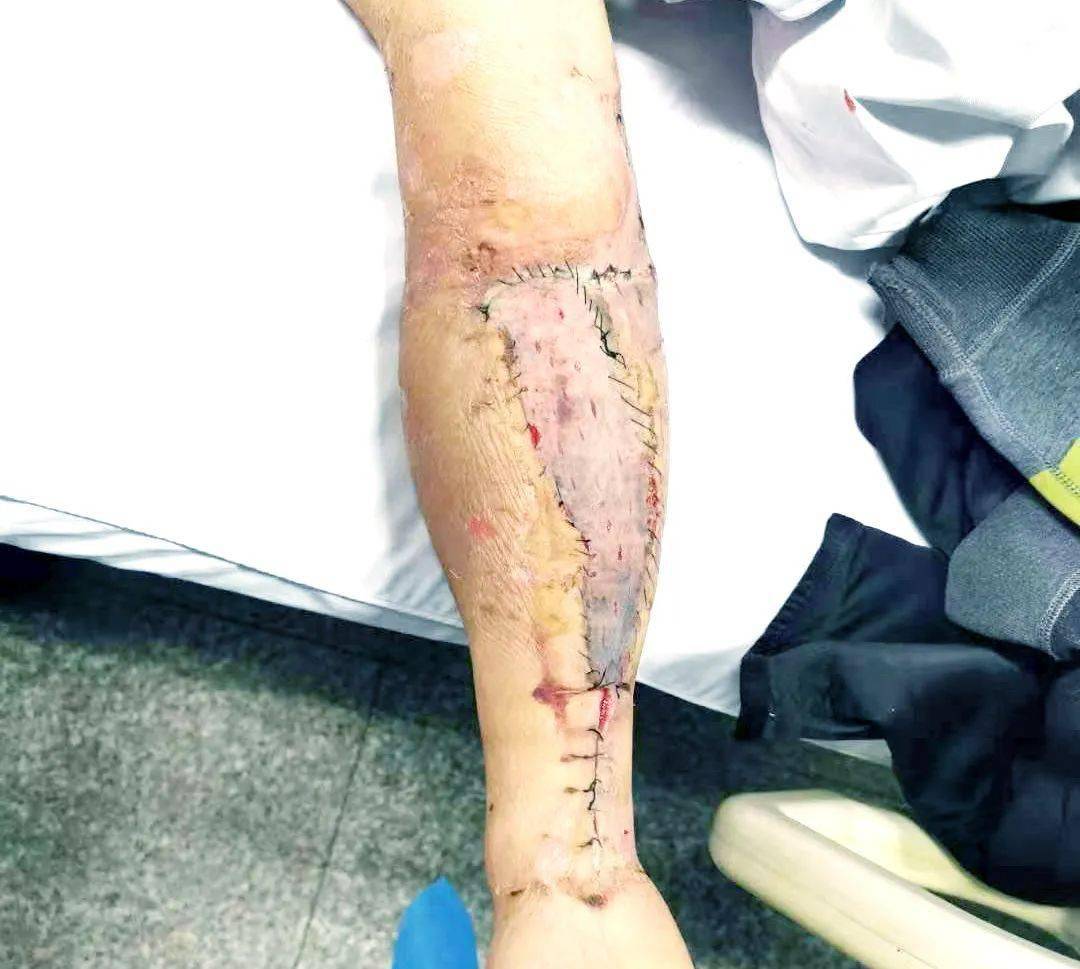 【链接】断肢再植术是采取手术的方法,将断肢重新接回原位,使患者恢复