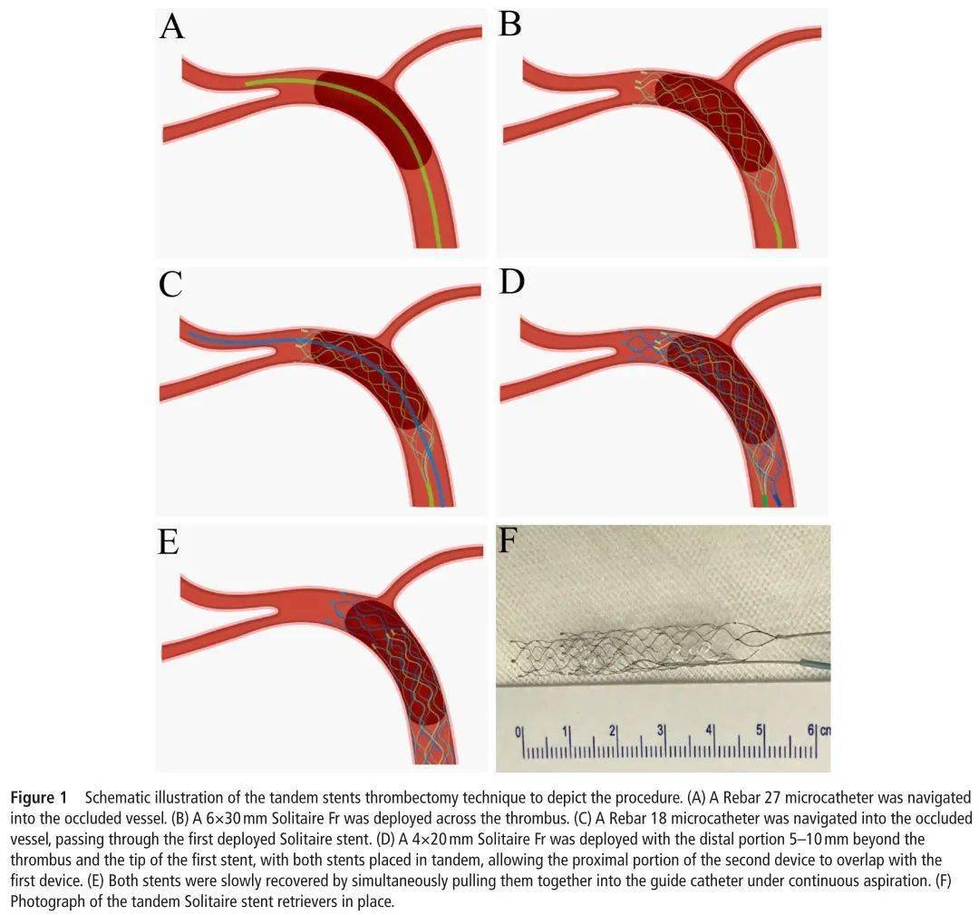 014英寸的微导丝(traxcess(microvention)或synchro(stryker