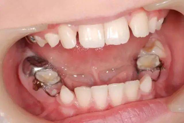 小心毁了孩子的一口好牙!