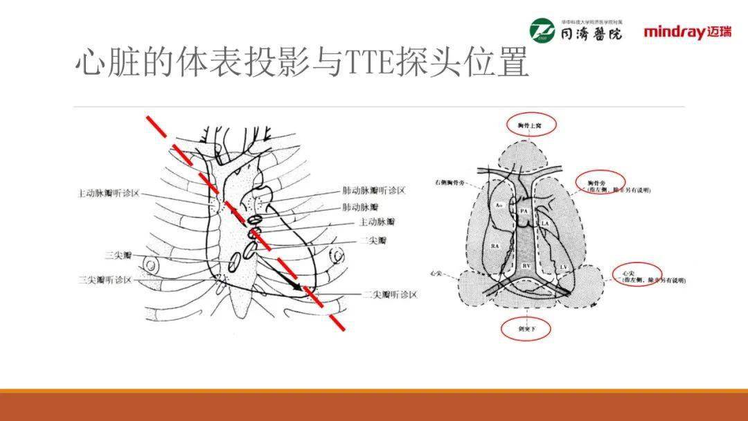 武汉同济医院麻醉科围术期经胸超声心动图tte