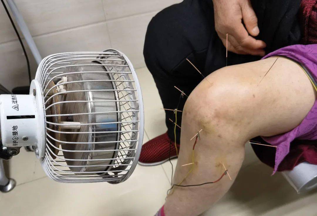 傅鸿亮,针灸康复有一手!
