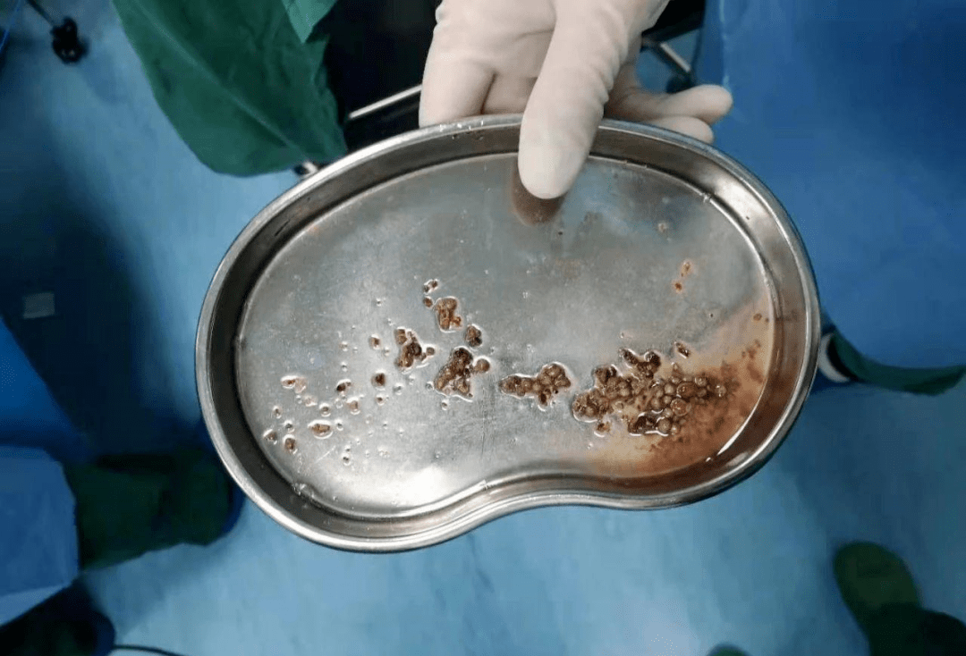 据泌外科医师介绍,经皮肾镜钬激光碎石取石术是目前医治肾结石比较