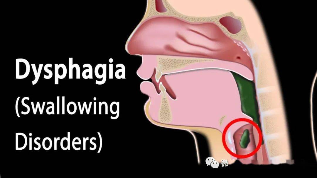 脑卒中吞咽障碍的物理因子治疗