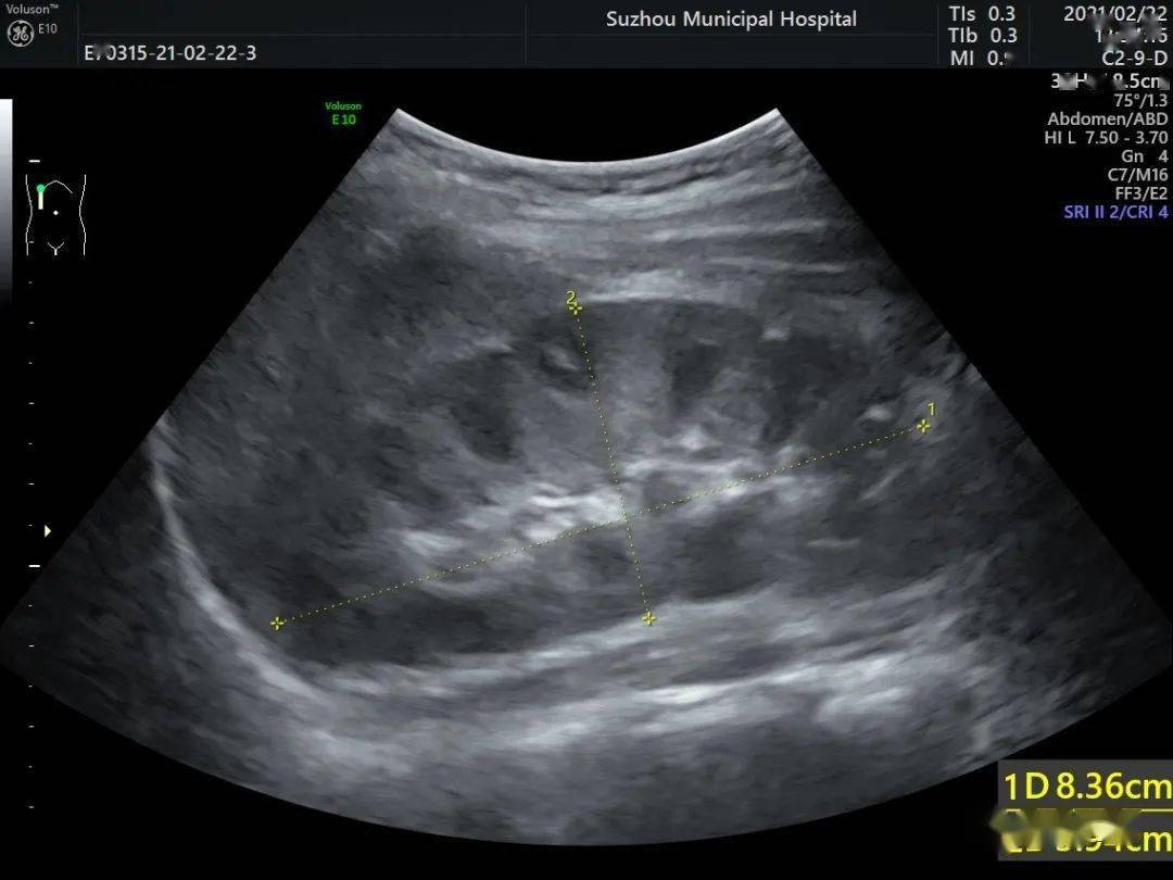 超声诊断:右肾异位,盆腔肾.祝福孩子,应该有一个光辉的未来.