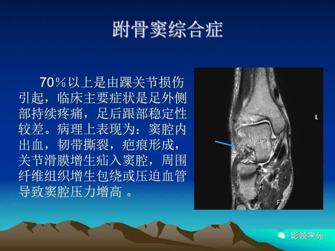 踝关节韧带或其他软组织损伤可能会导致较严重的创伤性骨关节炎,骨质