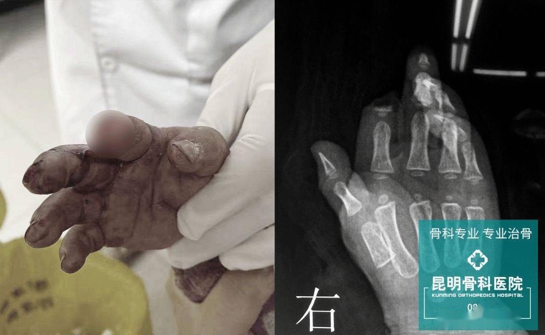 惋惜2岁男童手指离断粗心父母忘带手指到院