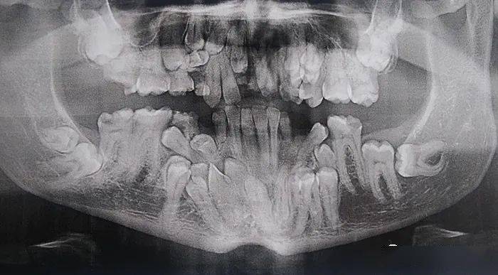 婴儿头部x光都是牙齿图片