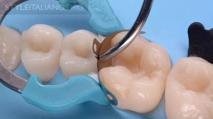 牙医学堂如何使用成形片恢复功能性邻面外形