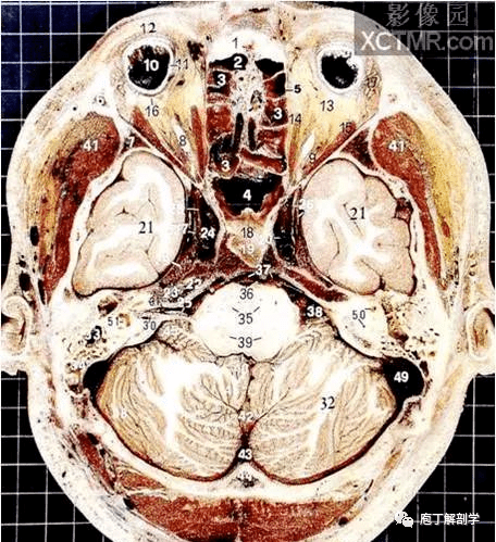 2,额窦 3,筛小房 4,蝶窦5,筛骨眶板 6,额骨颧突7,蝶骨大翼 8,视神经9