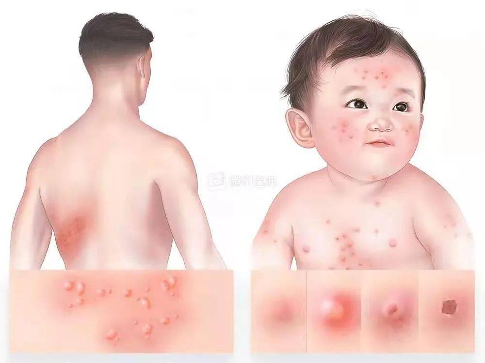 疱疹是什么原因引起的怎么治疗 f48b811a93da4190afff1ac6bd20c13d.jpeg