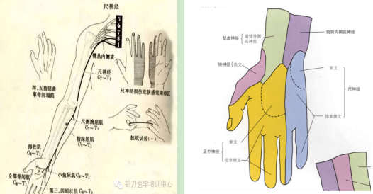 引以为戒 穿刺致尺神经损伤 转发提醒所有人 患者