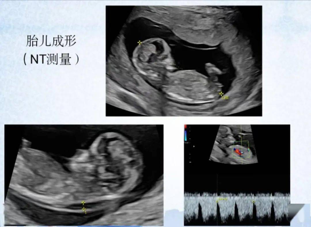 通常在孕11~13 6周进行,如果nt值检超过标准值,则可能与胎儿染色体