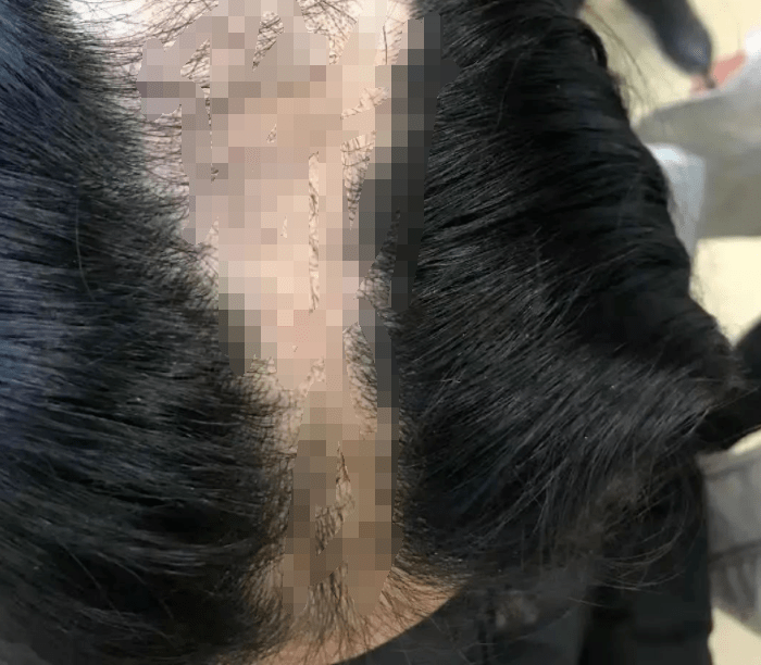 11岁女孩掉头发为什么