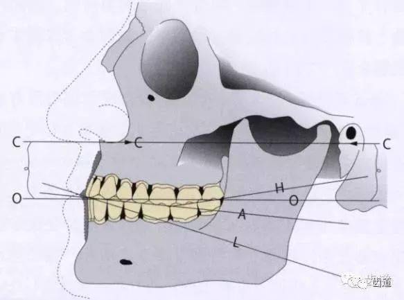 关于禾平衡的全口义齿咬合论战(全文)_平面