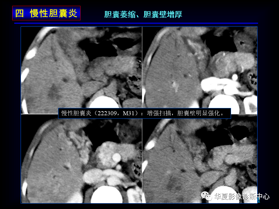 膽囊炎影像診斷