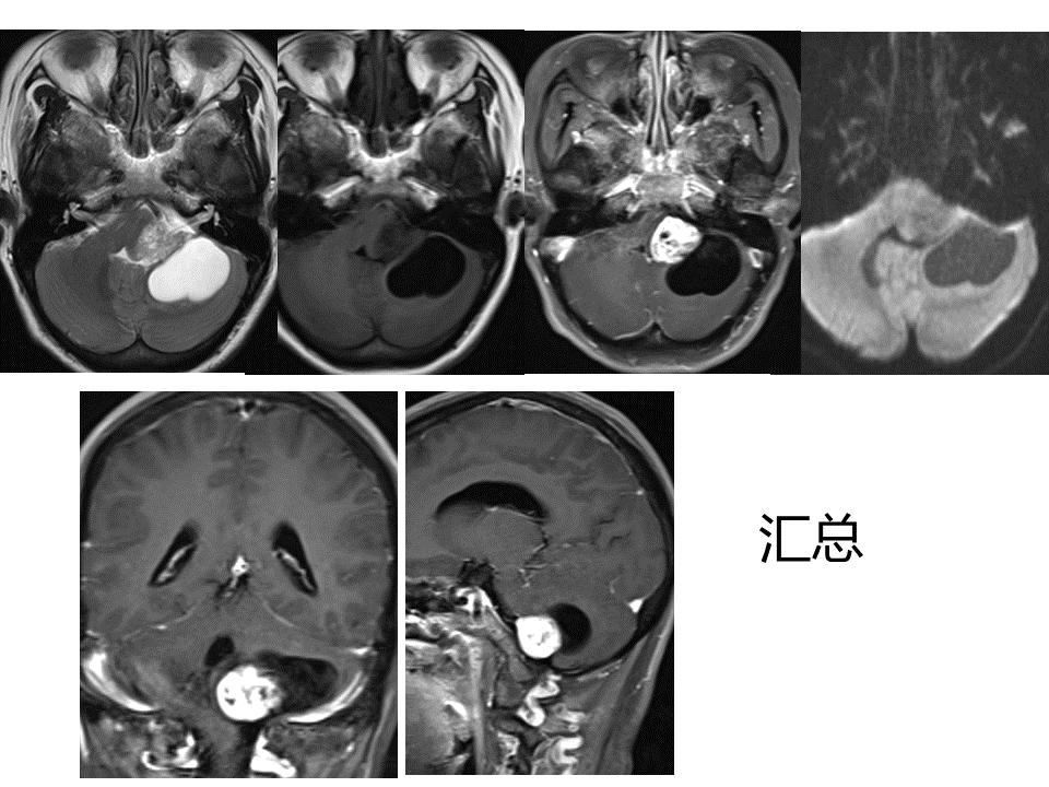 桥小脑角脂肪瘤图片
