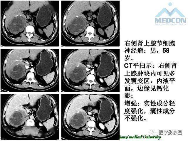 踝关节外侧韧带急性损伤的mri表现