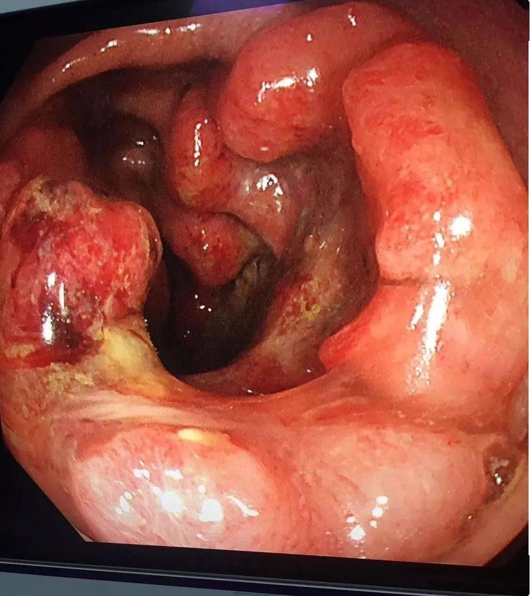 肠镜发现结肠环腔隆起性病变,表面覆污秽苔.