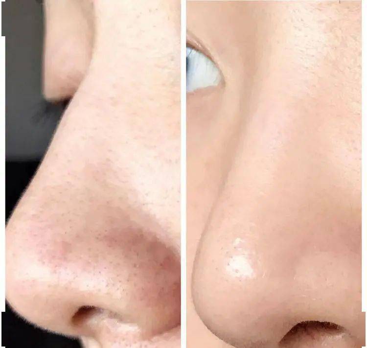 "怎样才能背着女友,偷偷和前任联系?"_祛痘