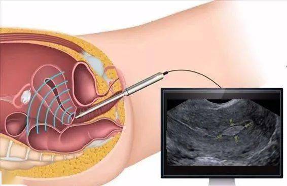 子宫内膜息肉怎样根治图片