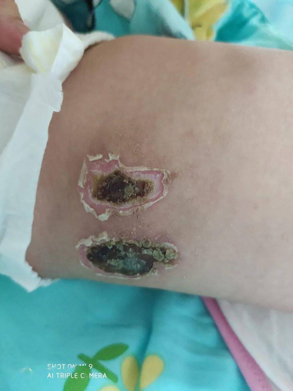 热水袋也会有危险