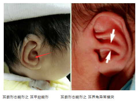 全国爱耳日原来耳朵也有畸形出生后这个时间段矫正才有用