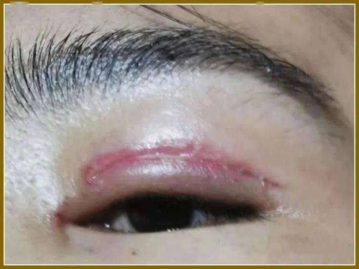 重睑术并发症及其预防和处理
