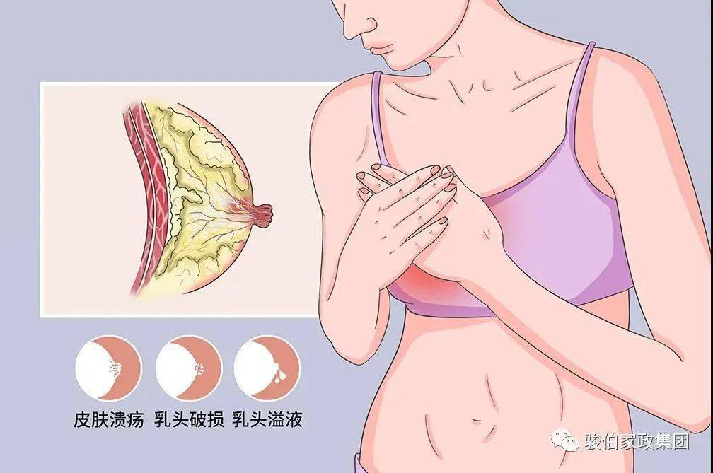 开奶涨奶乳头白点哺乳问题大解析