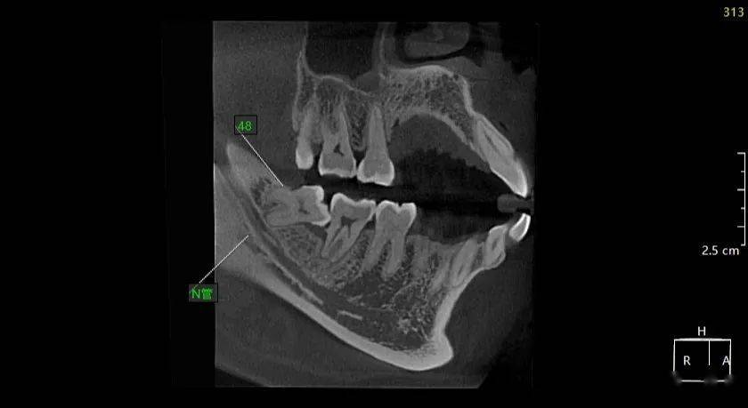 胡xx 20210306 智齒cbct 137xxxx0605