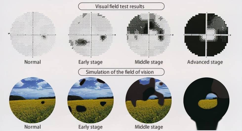 视野缺损图解图片