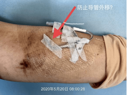 这样固定导管穿刺点小心官司找上你